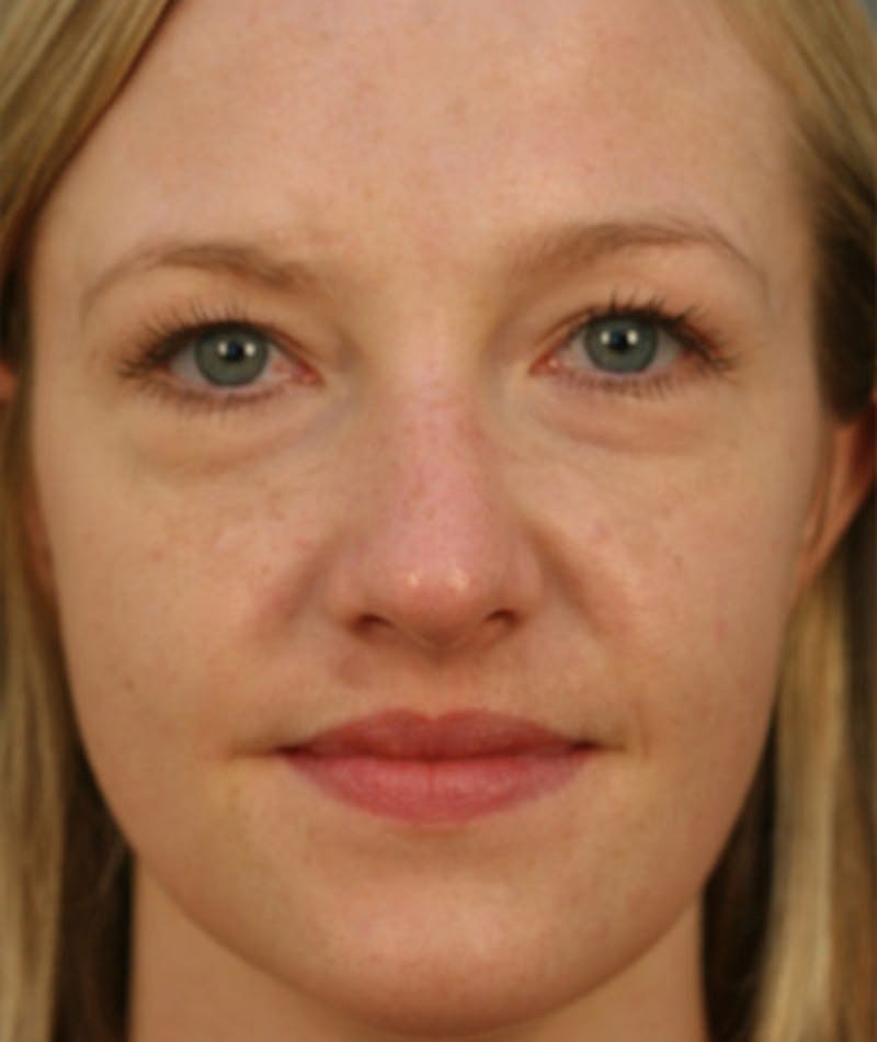 Primary Rhinoplasty Before & After Gallery - Patient 108174182 - Image 3
