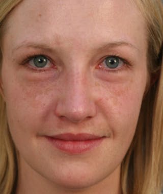 Primary Rhinoplasty Before & After Gallery - Patient 108174182 - Image 4