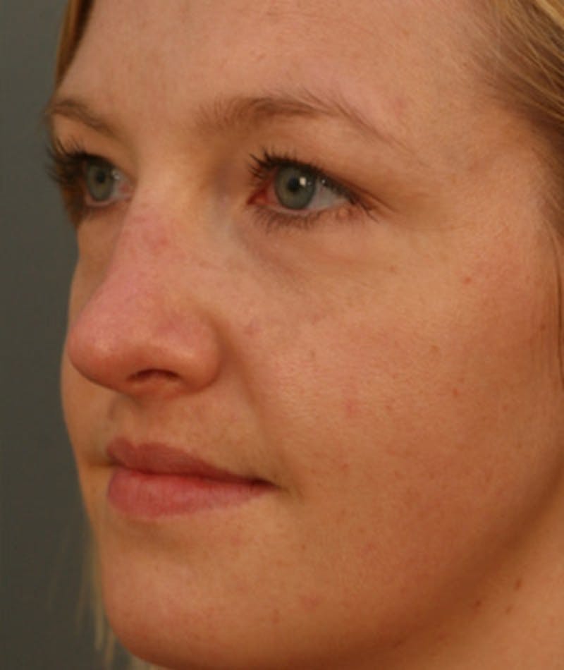 Primary Rhinoplasty Before & After Gallery - Patient 108174182 - Image 5