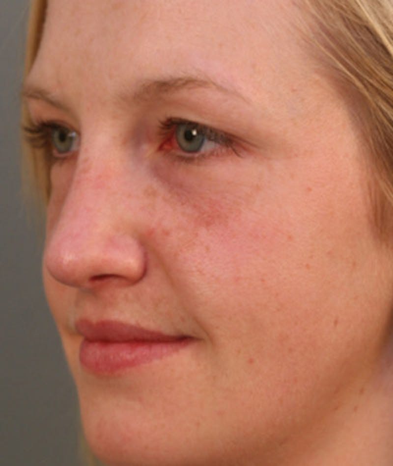 Primary Rhinoplasty Before & After Gallery - Patient 108174182 - Image 6