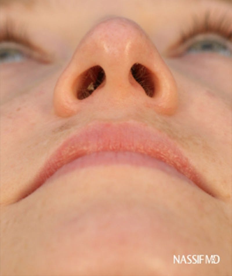 Primary Rhinoplasty Before & After Gallery - Patient 108174182 - Image 7