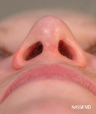 Primary Rhinoplasty Before & After Gallery - Patient 108174182 - Image 8