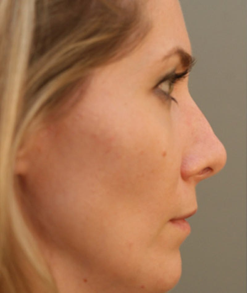 Primary Rhinoplasty Before & After Gallery - Patient 108174183 - Image 1
