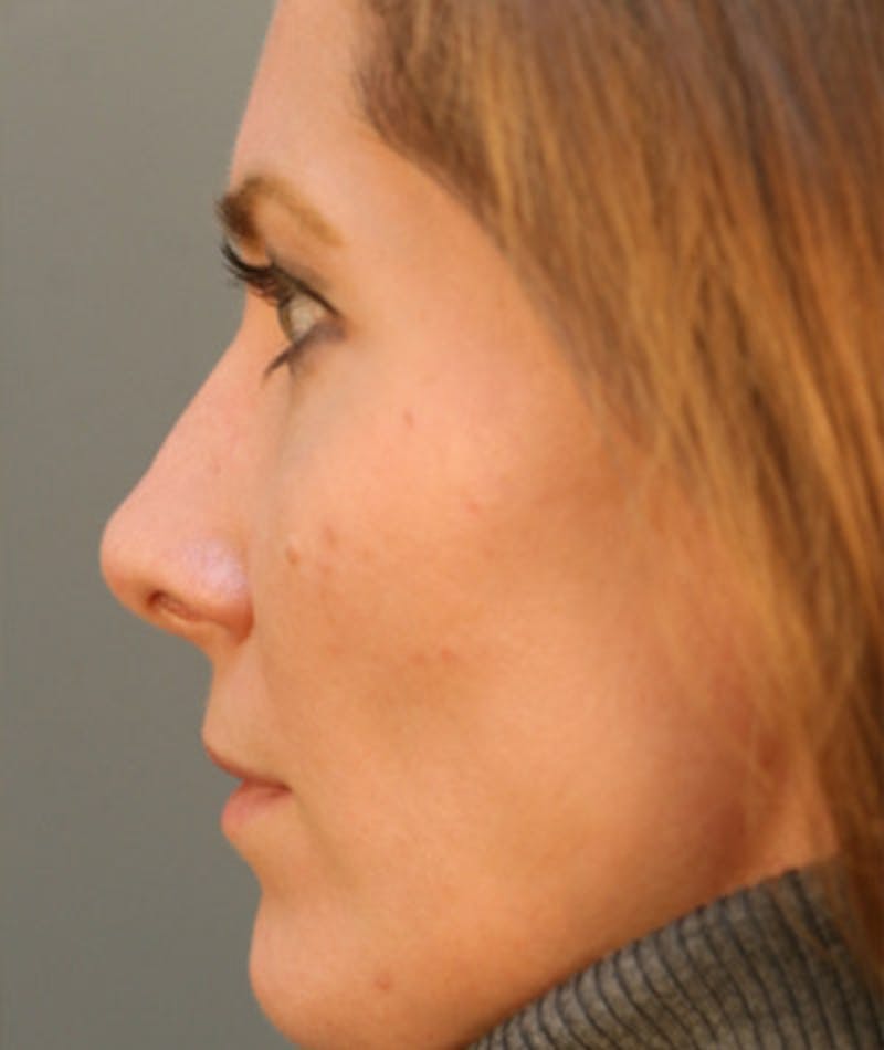 Primary Rhinoplasty Before & After Gallery - Patient 108174183 - Image 2