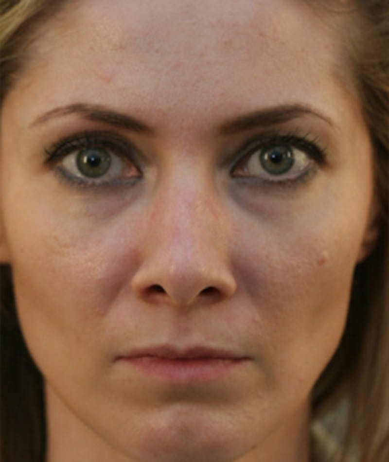 Primary Rhinoplasty Before & After Gallery - Patient 108174183 - Image 3