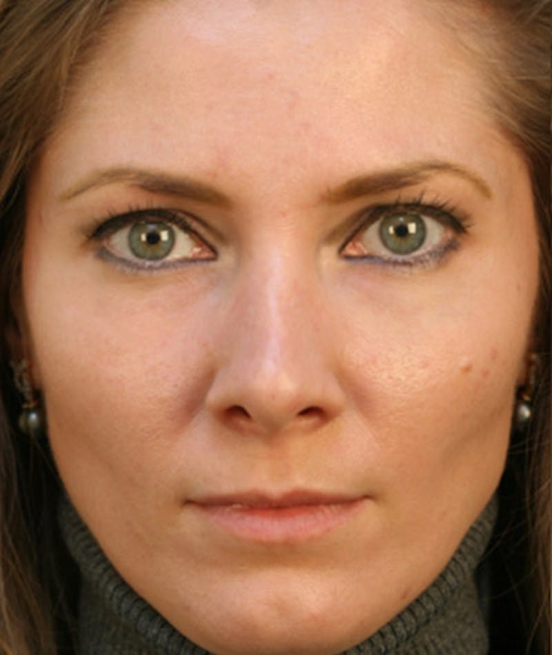 Primary Rhinoplasty Before & After Gallery - Patient 108174183 - Image 4