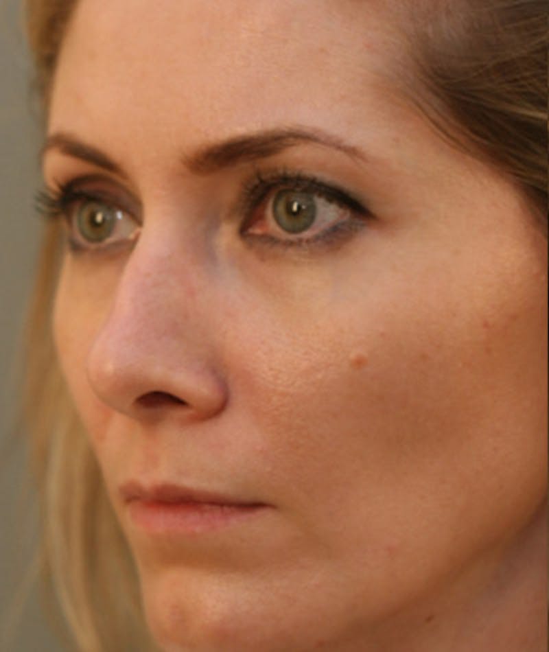 Primary Rhinoplasty Before & After Gallery - Patient 108174183 - Image 5
