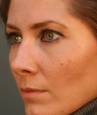 Primary Rhinoplasty Before & After Gallery - Patient 108174183 - Image 6