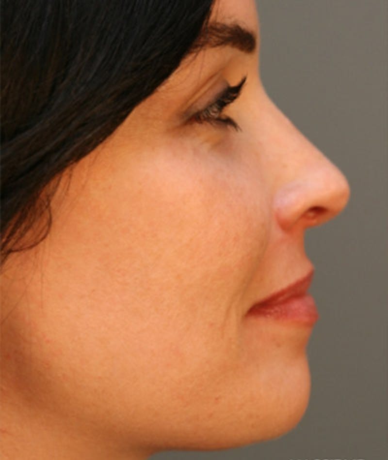 Primary Rhinoplasty Before & After Gallery - Patient 108174185 - Image 1