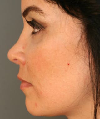 Primary Rhinoplasty Before & After Gallery - Patient 108174185 - Image 2