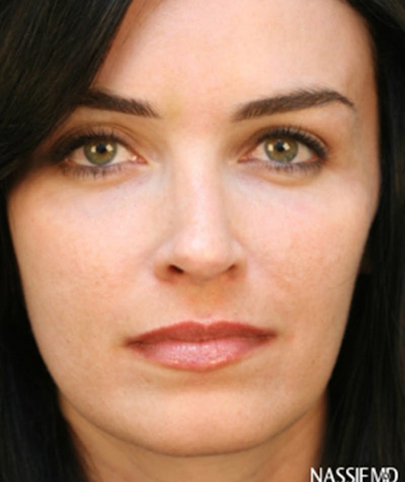 Primary Rhinoplasty Before & After Gallery - Patient 108174185 - Image 3