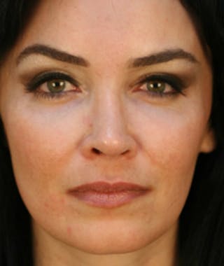 Primary Rhinoplasty Before & After Gallery - Patient 108174185 - Image 4