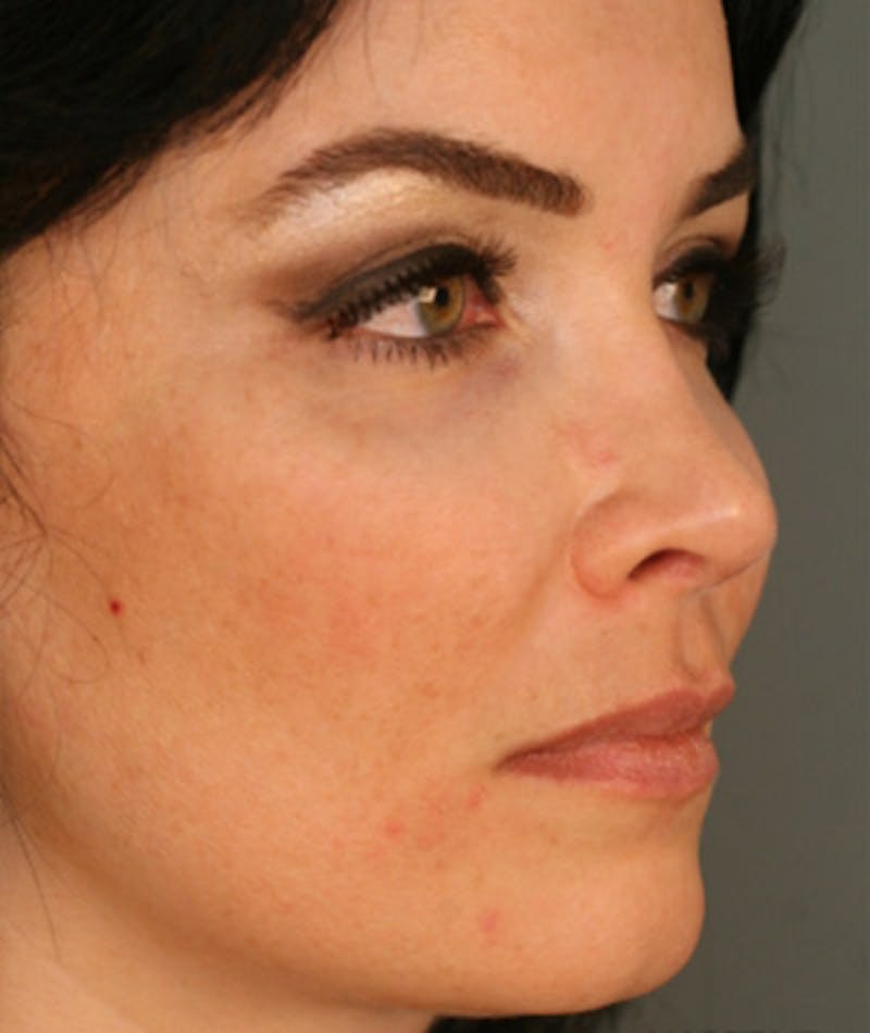 Primary Rhinoplasty Before & After Gallery - Patient 108174185 - Image 6