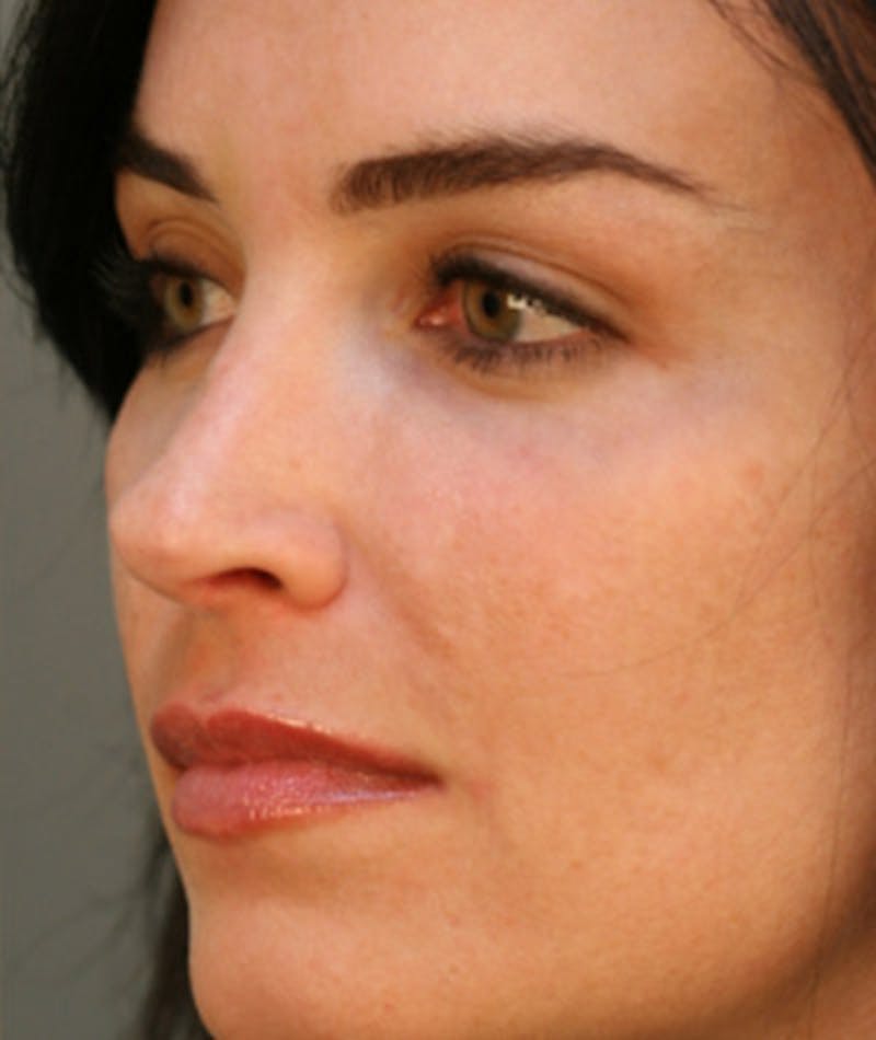 Primary Rhinoplasty Before & After Gallery - Patient 108174185 - Image 7