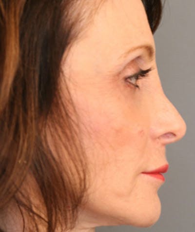 Primary Rhinoplasty Before & After Gallery - Patient 108174204 - Image 1