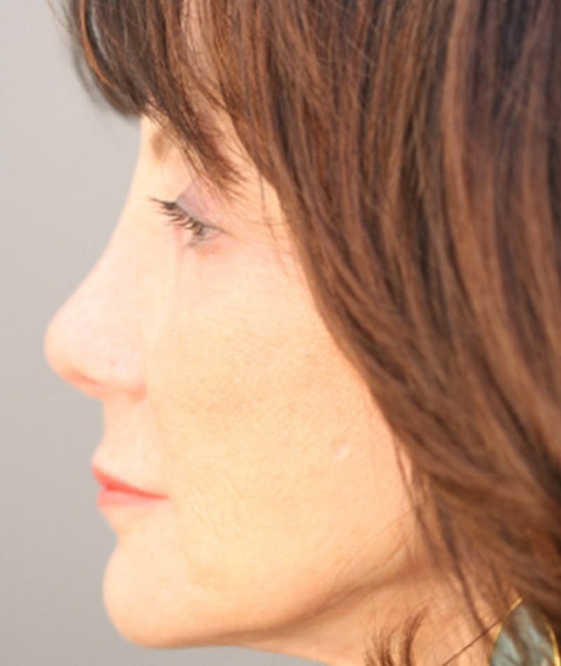 Primary Rhinoplasty Before & After Gallery - Patient 108174204 - Image 2