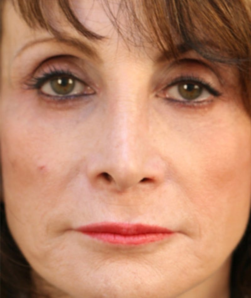 Primary Rhinoplasty Before & After Gallery - Patient 108174204 - Image 3
