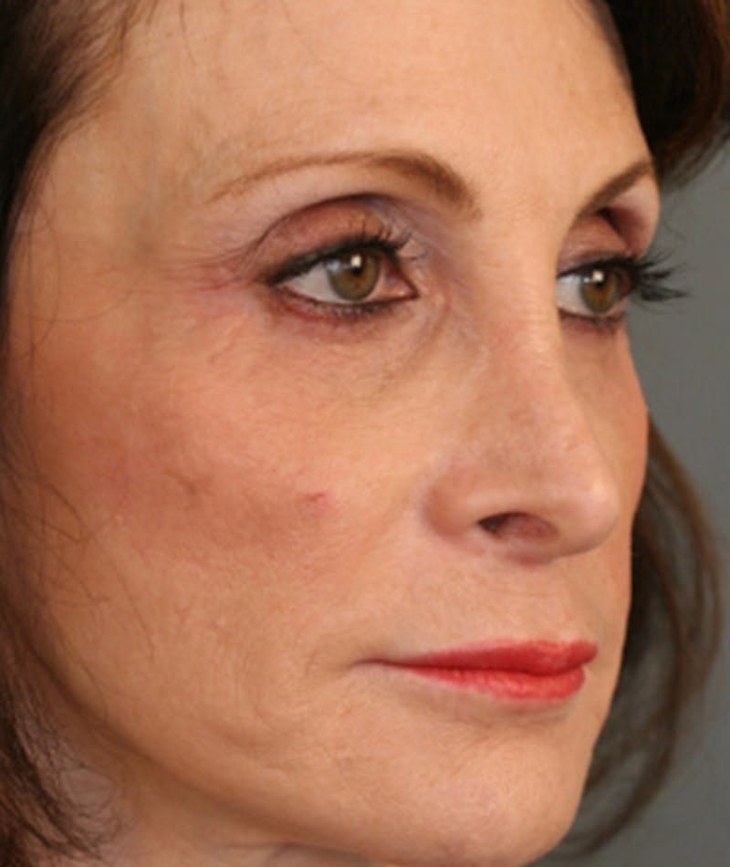 Primary Rhinoplasty Before & After Gallery - Patient 108174204 - Image 5