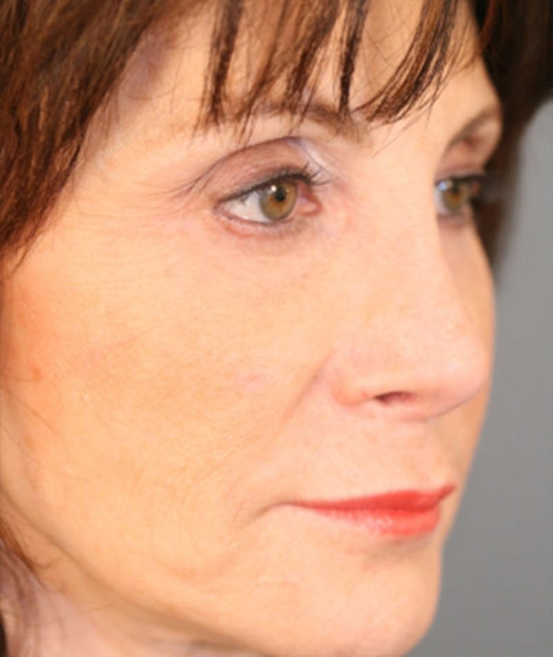 Primary Rhinoplasty Before & After Gallery - Patient 108174204 - Image 6