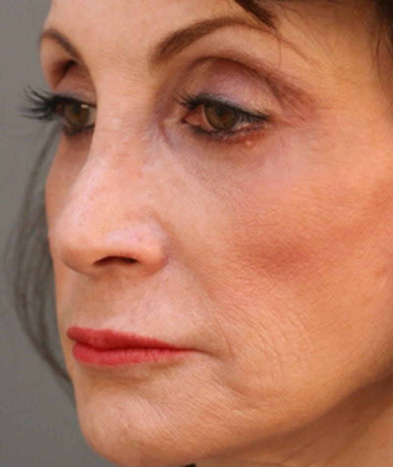 Primary Rhinoplasty Before & After Gallery - Patient 108174204 - Image 7