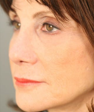 Primary Rhinoplasty Before & After Gallery - Patient 108174204 - Image 8