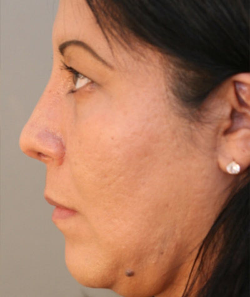 Primary Rhinoplasty Before & After Gallery - Patient 108174217 - Image 2