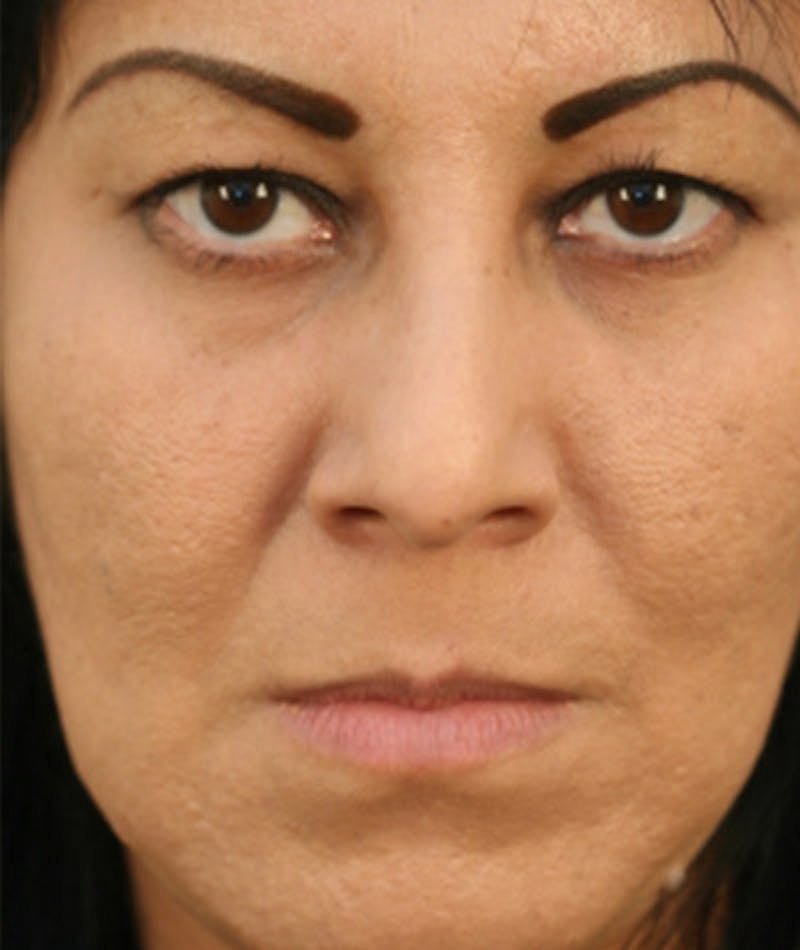 Primary Rhinoplasty Before & After Gallery - Patient 108174217 - Image 3