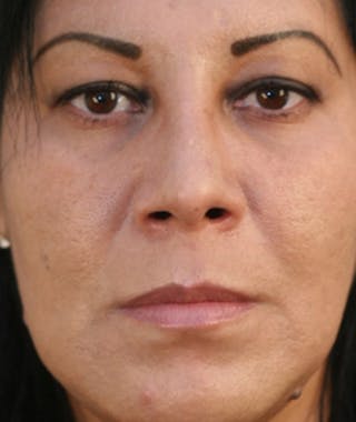 Primary Rhinoplasty Before & After Gallery - Patient 108174217 - Image 4