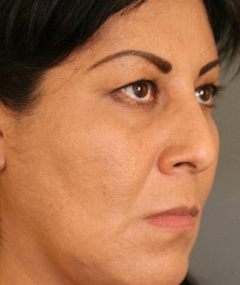 Primary Rhinoplasty Before & After Gallery - Patient 108174217 - Image 5