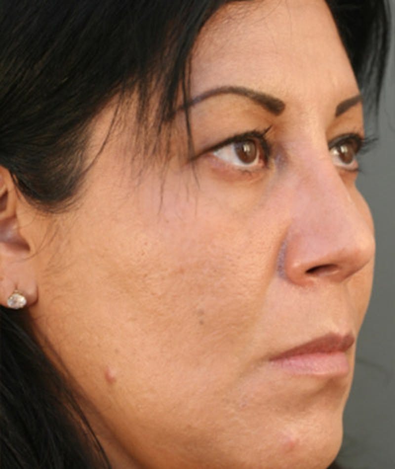 Primary Rhinoplasty Before & After Gallery - Patient 108174217 - Image 6