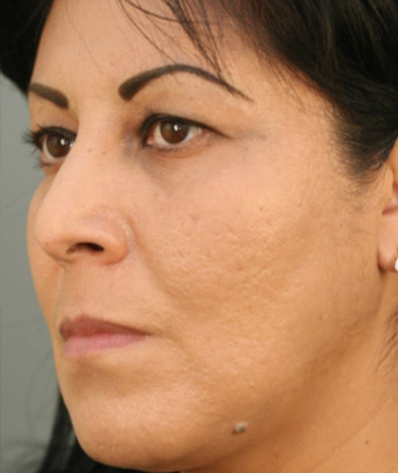 Primary Rhinoplasty Before & After Gallery - Patient 108174217 - Image 7