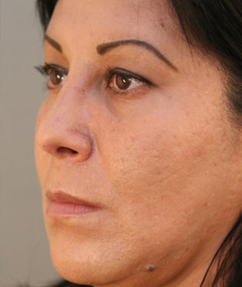 Primary Rhinoplasty Before & After Gallery - Patient 108174217 - Image 8