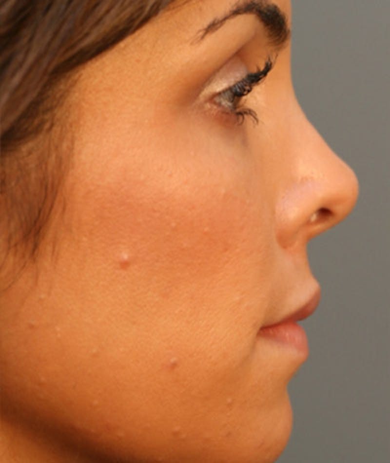 Primary Rhinoplasty Before & After Gallery - Patient 108174251 - Image 1