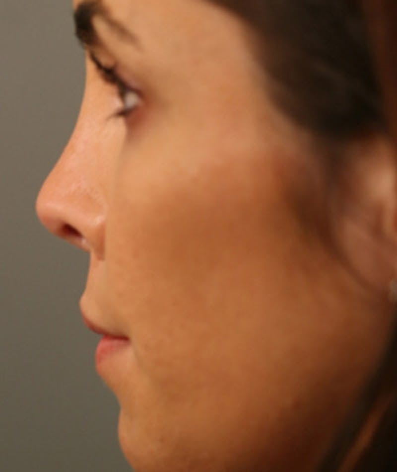 Primary Rhinoplasty Before & After Gallery - Patient 108174251 - Image 2