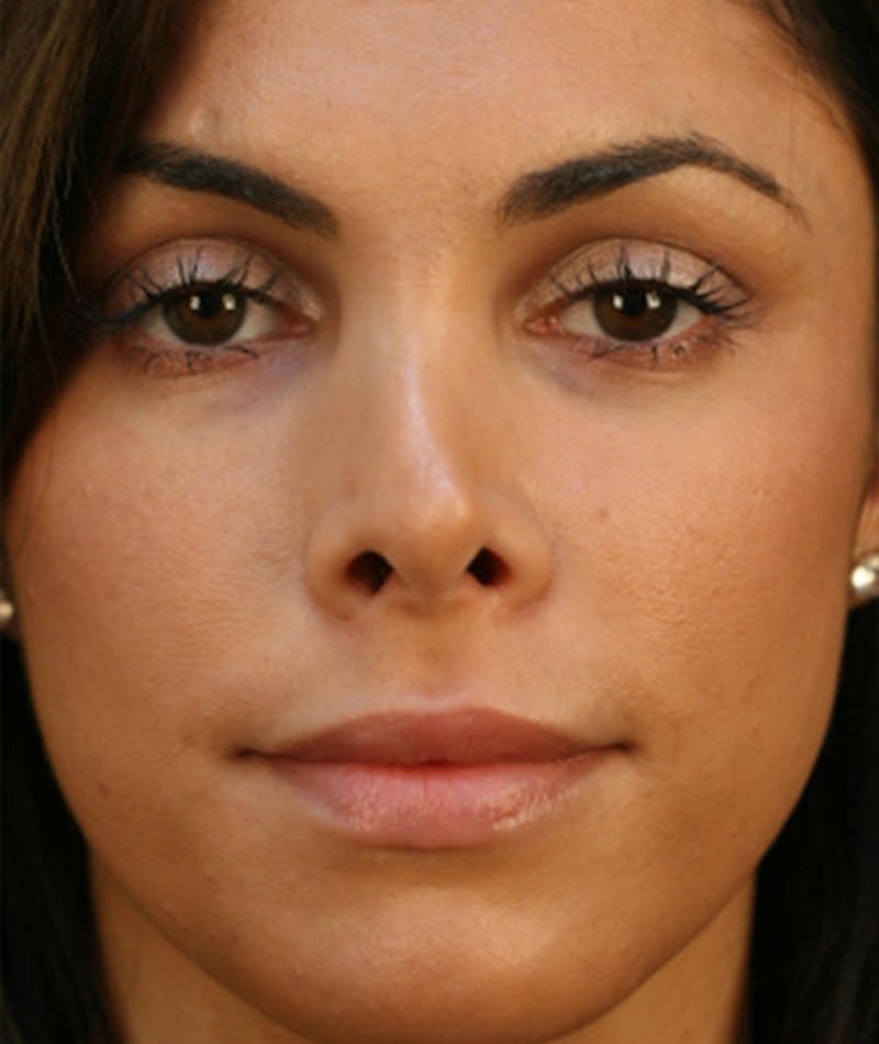 Primary Rhinoplasty Before & After Gallery - Patient 108174251 - Image 3