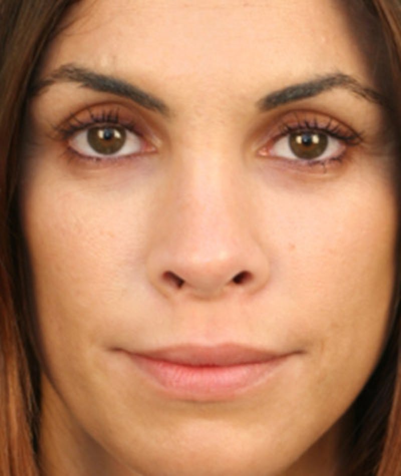 Primary Rhinoplasty Before & After Gallery - Patient 108174251 - Image 4