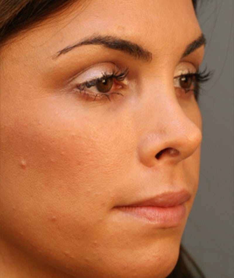 Primary Rhinoplasty Before & After Gallery - Patient 108174251 - Image 5