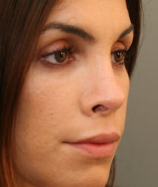 Primary Rhinoplasty Before & After Gallery - Patient 108174251 - Image 6