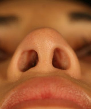 Primary Rhinoplasty Before & After Gallery - Patient 108174251 - Image 8