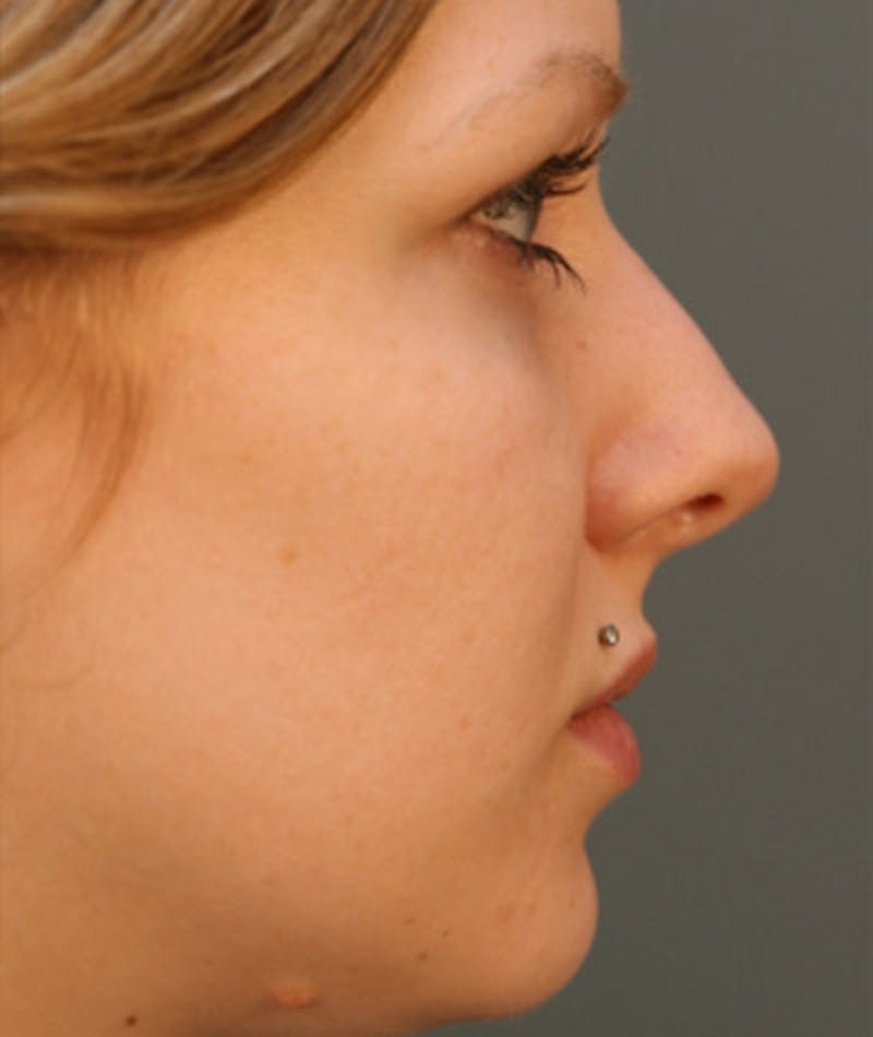 Primary Rhinoplasty Before & After Gallery - Patient 108174254 - Image 1