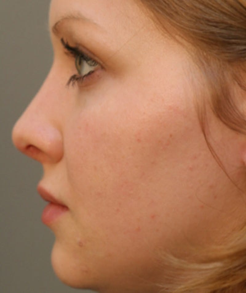 Primary Rhinoplasty Before & After Gallery - Patient 108174254 - Image 2
