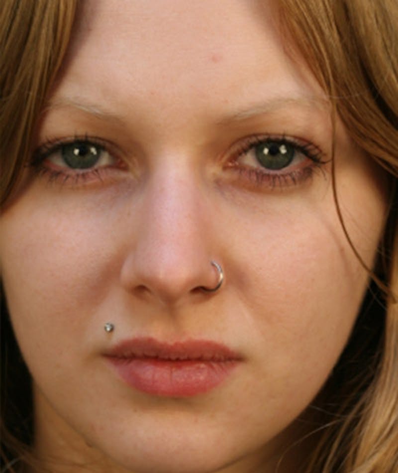 Primary Rhinoplasty Before & After Gallery - Patient 108174254 - Image 3