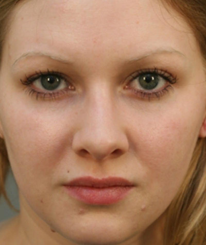 Primary Rhinoplasty Before & After Gallery - Patient 108174254 - Image 4