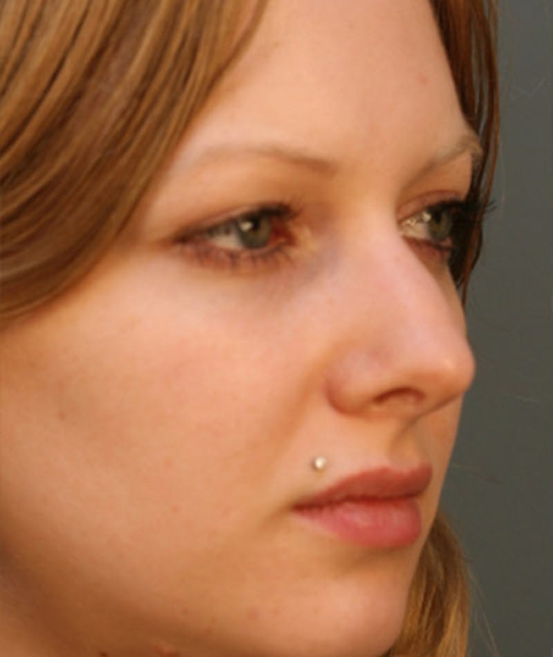 Primary Rhinoplasty Before & After Gallery - Patient 108174254 - Image 5