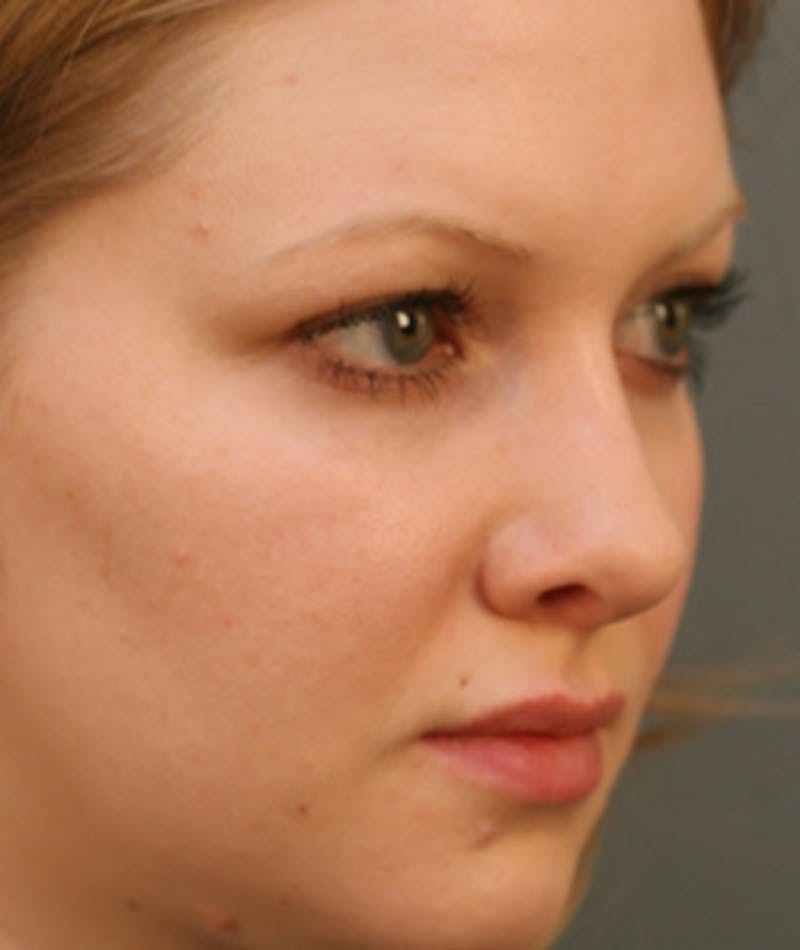 Primary Rhinoplasty Before & After Gallery - Patient 108174254 - Image 6