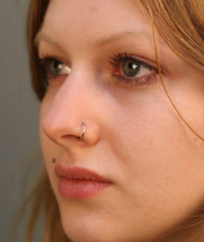 Primary Rhinoplasty Before & After Gallery - Patient 108174254 - Image 7