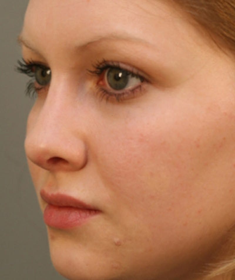 Primary Rhinoplasty Before & After Gallery - Patient 108174254 - Image 8