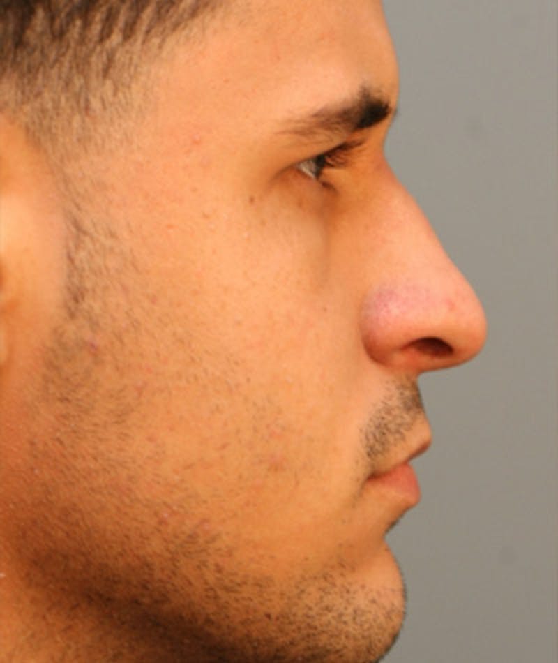 Primary Rhinoplasty Before & After Gallery - Patient 108174264 - Image 1