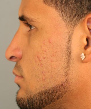 Primary Rhinoplasty Before & After Gallery - Patient 108174264 - Image 2