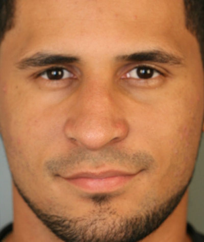 Primary Rhinoplasty Before & After Gallery - Patient 108174264 - Image 4